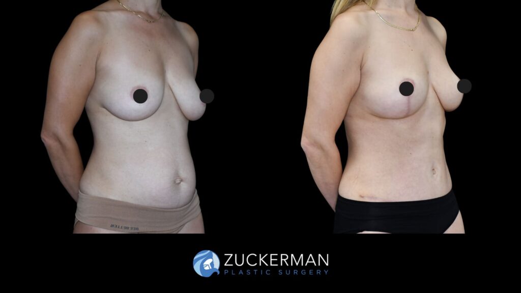 Patient before and after Tummy Tuck and Mastopexy | Zuckerman Plastic Surgery