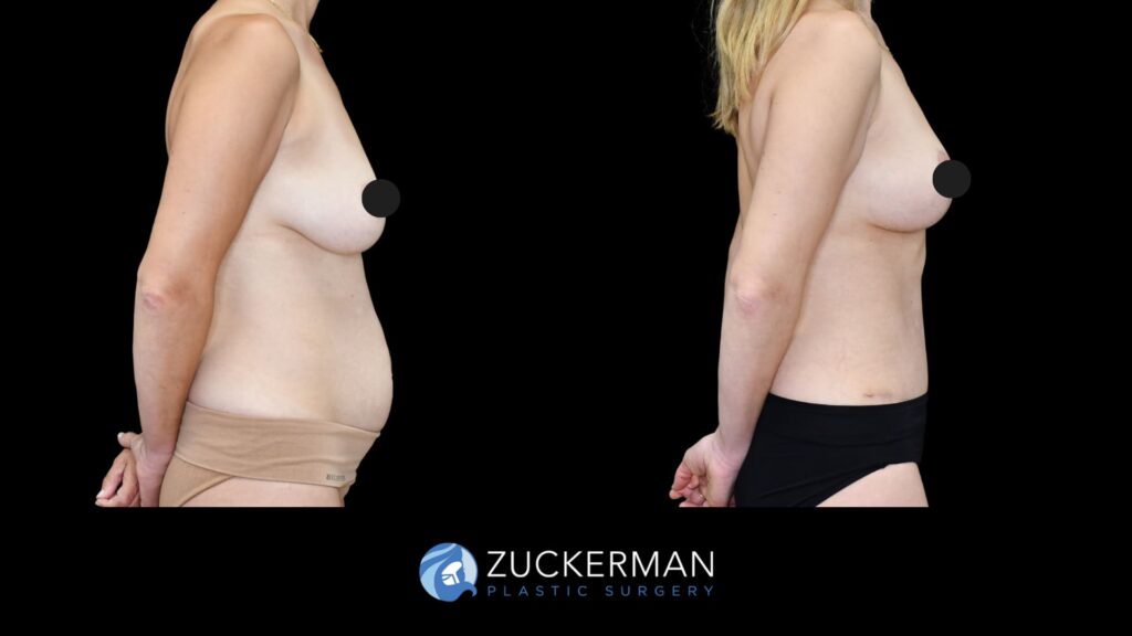 Patient before and after Tummy Tuck and Mastopexy | Zuckerman Plastic Surgery