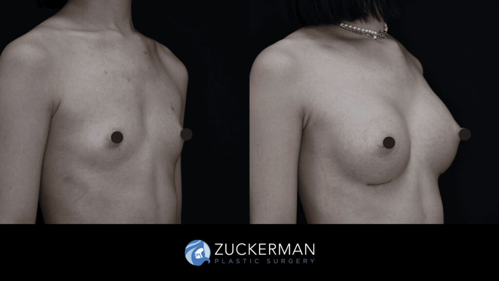 Patient before and after Breast Augmentation | Zuckerman Plastic Surgery