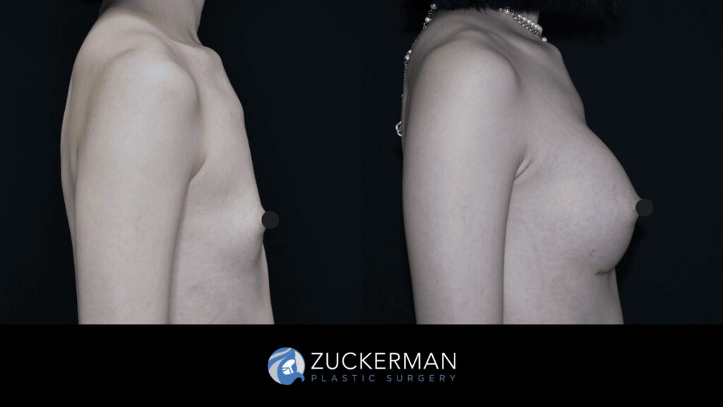 Patient before and after Breast Augmentation | Zuckerman Plastic Surgery