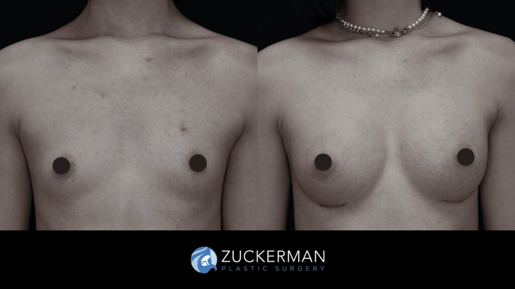 Patient before and after Breast Augmentation | Zuckerman Plastic Surgery