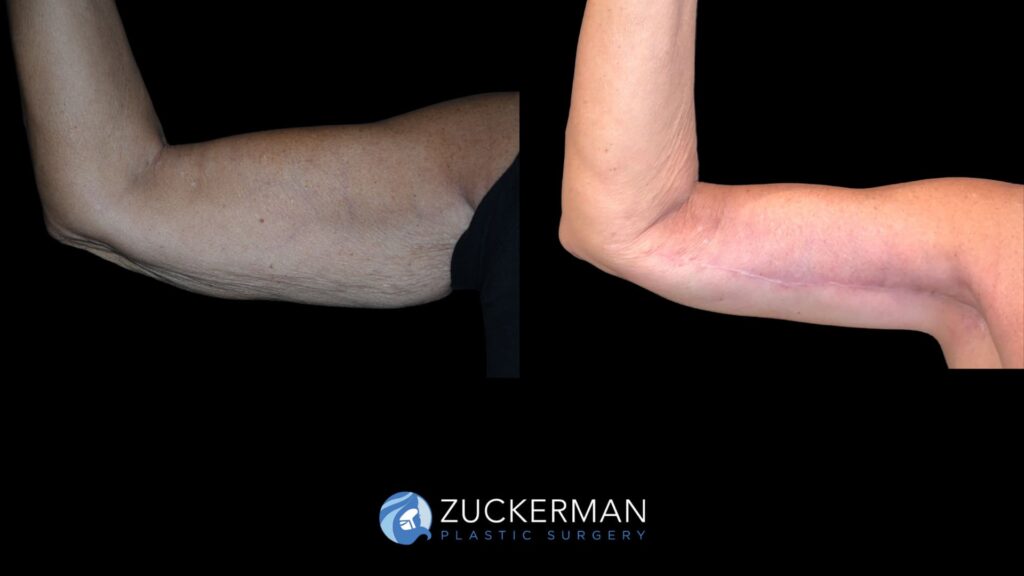 Patient results before and after brachioplasty performed by Dr. Zuckerman, showing improved contour and tightening of the upper arms, front view.
