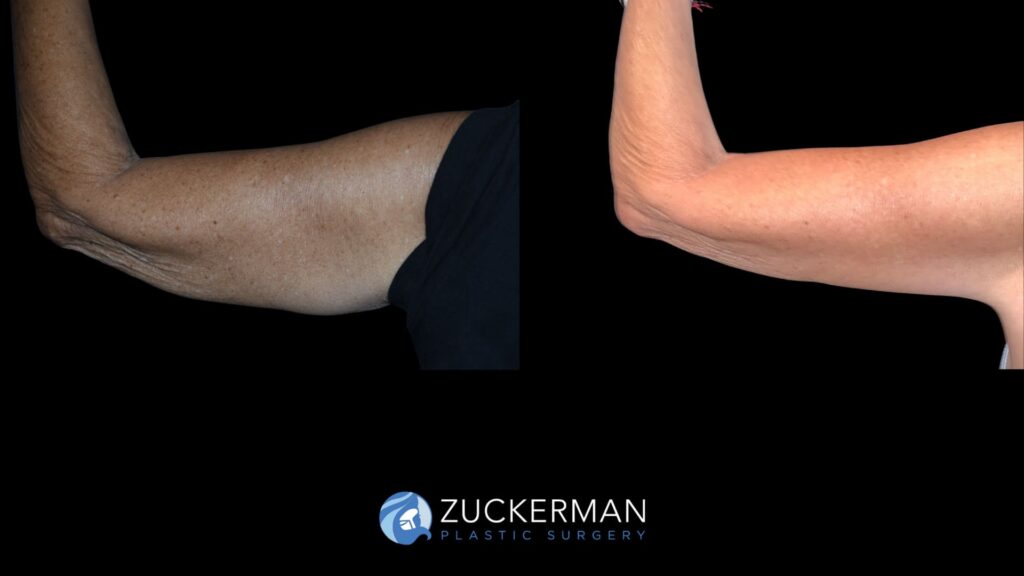 Patient results before and after brachioplasty performed by Dr. Zuckerman, showing improved contour and tightening of the upper arms, back view.