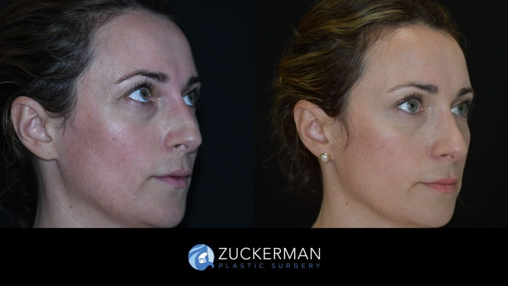 Patient before and after upper eyelid surgery (blepharoplasty) by Dr. Zuckerman, showing lifted and rejuvenated eyelids.