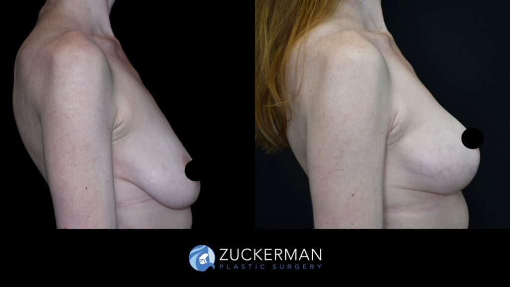 Patent before and after Mastopexy | Zuckerman Plastic Surgery