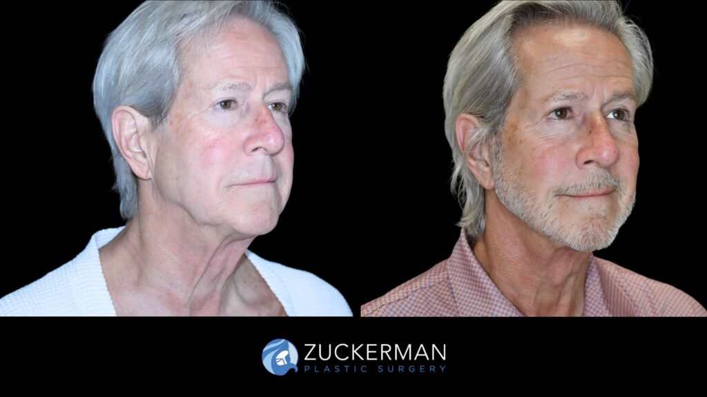 Patient results before and after face and neck lift performed by Dr. Zuckerman, showing enhanced jawline and neck definition, right oblique view.
