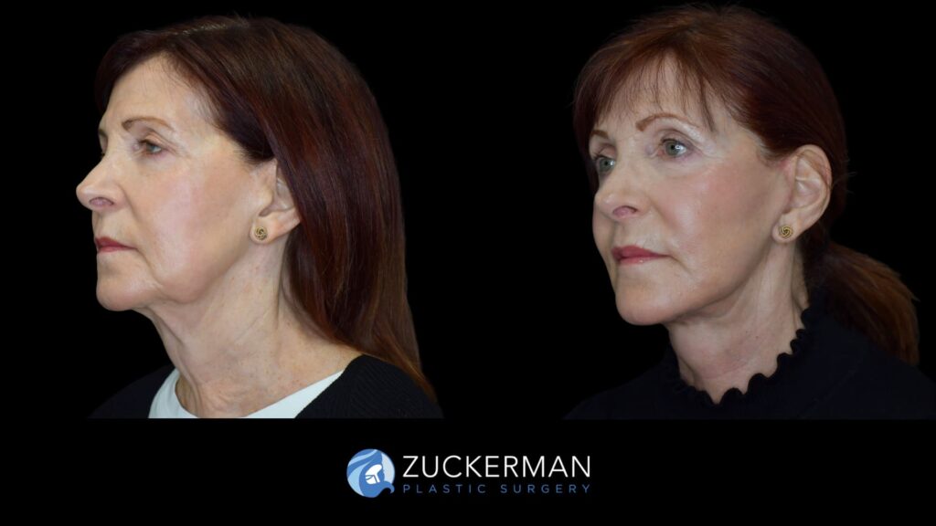Patient results before and after face and neck lift performed by Dr. Zuckerman, showing enhanced jawline and neck definition, left oblique view.