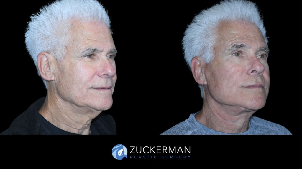 Patient results before and after face and neck lift performed by Dr. Zuckerman, showing enhanced jawline and neck definition, right oblique view.