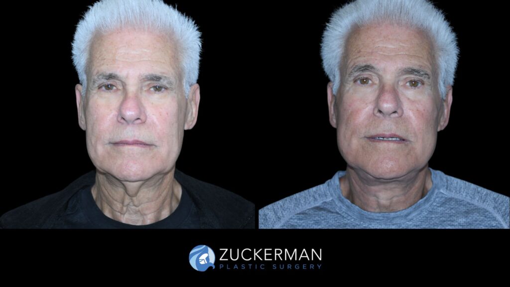 Patient results before and after face and neck lift performed by Dr. Zuckerman, showing enhanced jawline and neck definition, front view.