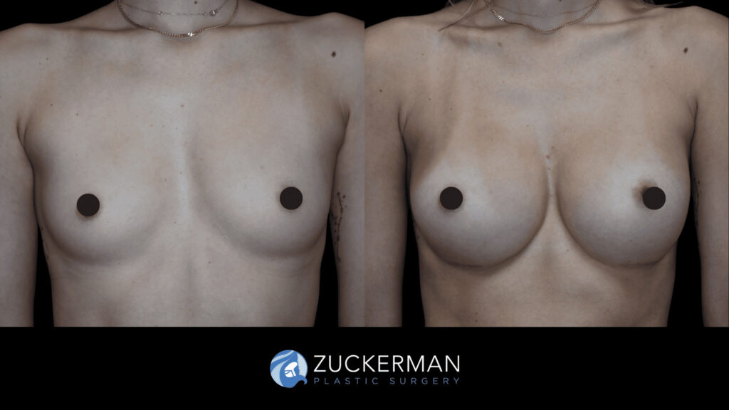 Patient before and after Breast Augmentation | Zuckerman Plastic Surgery