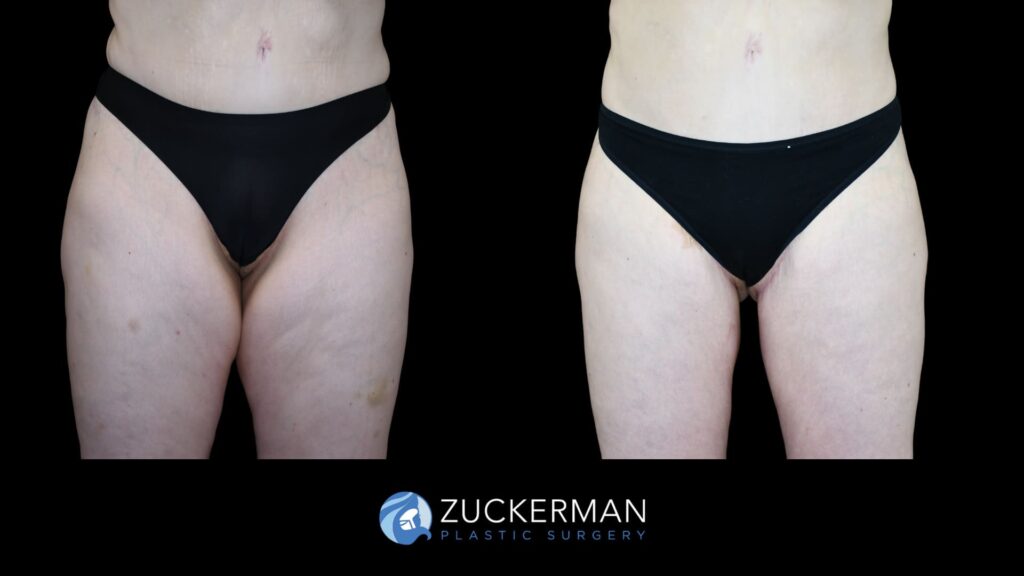 Before and after images of Crescent Thigh Lift performed by Dr. Zuckerman, showcasing improved contour and smoothness.