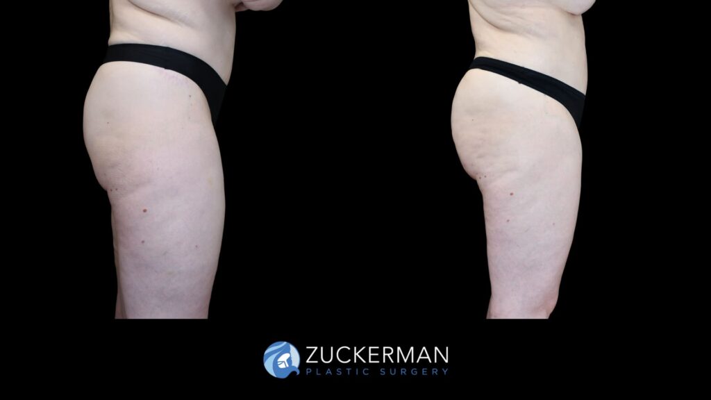Before and after images of Crescent Thigh Lift performed by Dr. Zuckerman, showcasing improved contour and smoothness.
