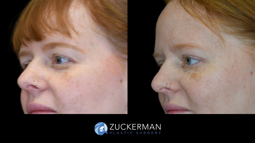 Patient before and after upper eyelid surgery (blepharoplasty) by Dr. Zuckerman, showing lifted and rejuvenated eyelids.