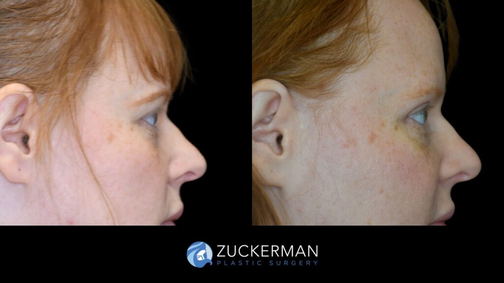 Patient before and after upper eyelid surgery (blepharoplasty) by Dr. Zuckerman, showing lifted and rejuvenated eyelids.