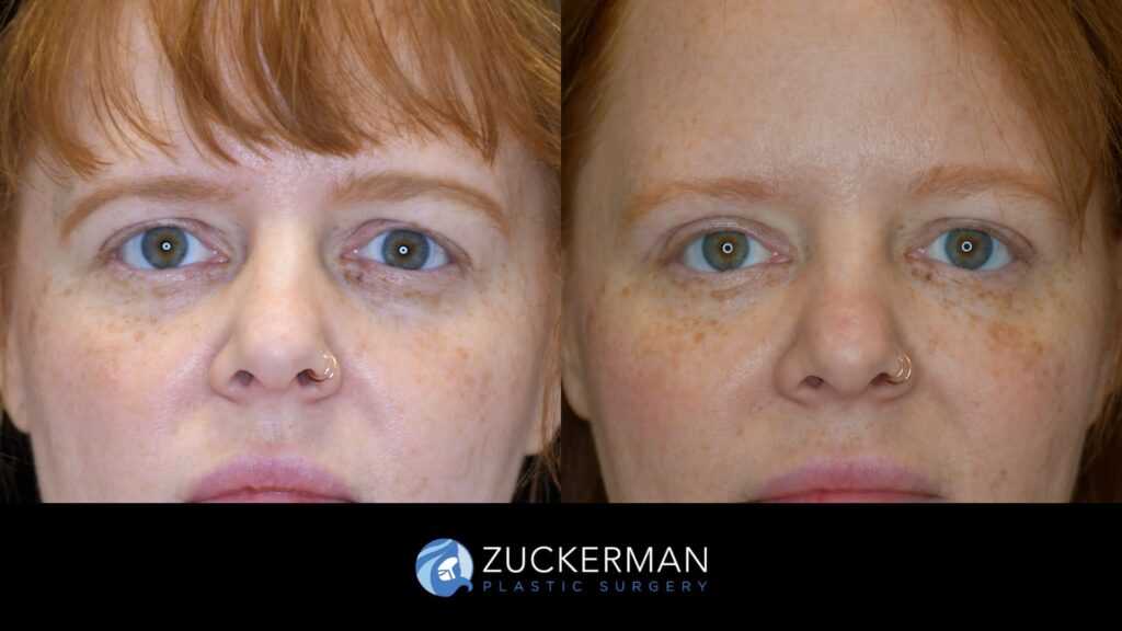 Patient before and after upper eyelid surgery (blepharoplasty) by Dr. Zuckerman, showing lifted and rejuvenated eyelids.