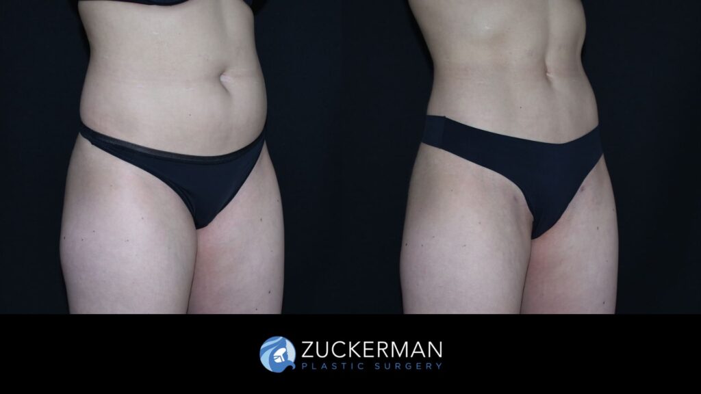 Before and after Liposuction by Dr. Zuckerman.