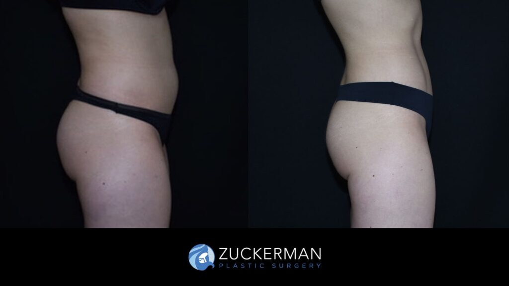 Before and after Liposuction by Dr. Zuckerman.