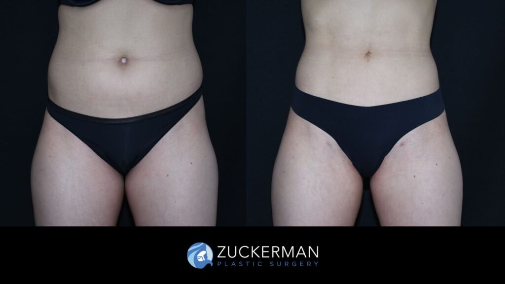 Before and after Liposuction by Dr. Zuckerman.
