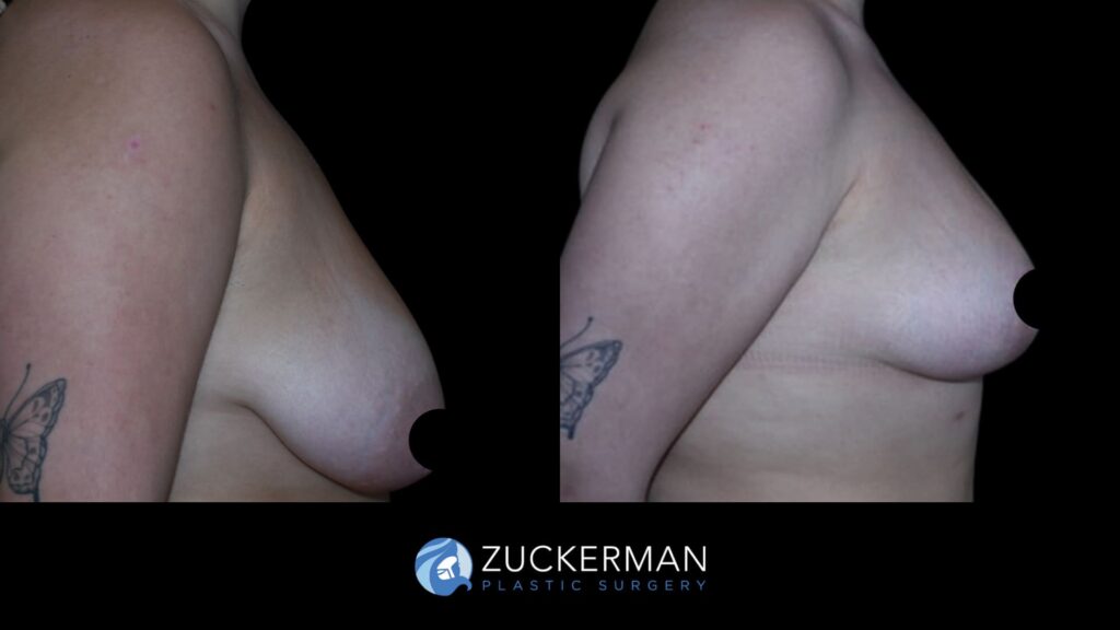 Patent before and after Mastopexy | Zuckerman Plastic Surgery