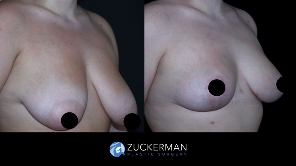 Patent before and after Mastopexy | Zuckerman Plastic Surgery