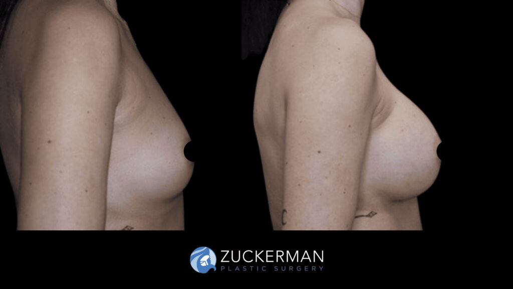 Patient before and after Breast Augmentation | Zuckerman Plastic Surgery