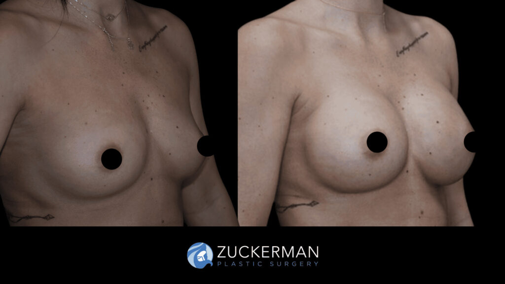 Patient before and after Breast Augmentation | Zuckerman Plastic Surgery