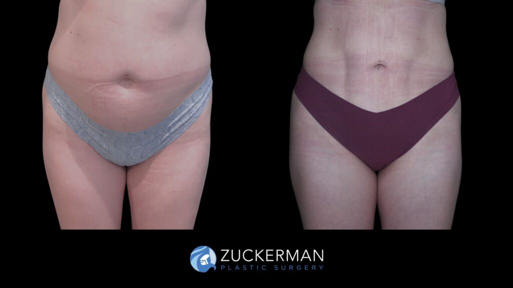 Before and after Liposuction by Dr. Zuckerman.