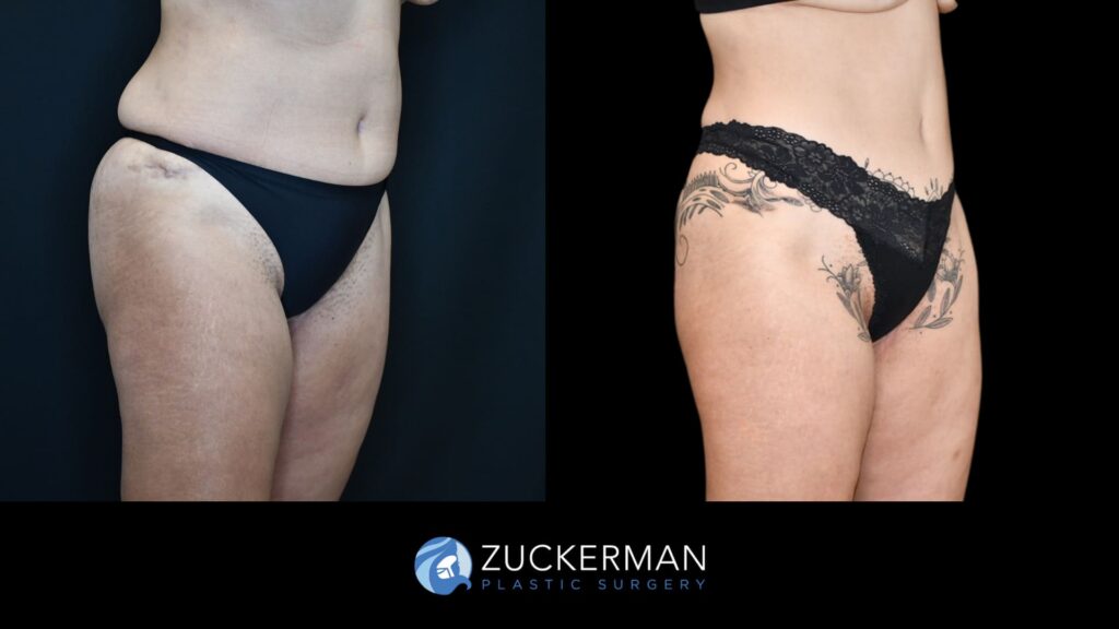 Before and after Liposuction by Dr. Zuckerman.