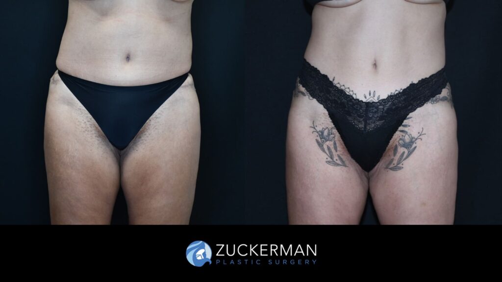 Before and after Liposuction by Dr. Zuckerman.
