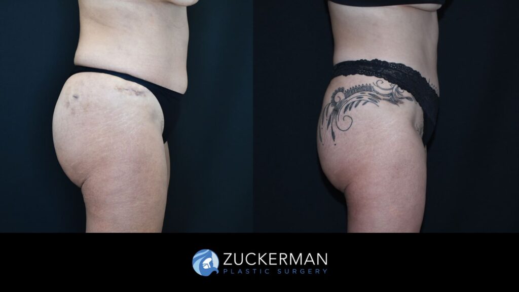 Before and after Liposuction by Dr. Zuckerman.