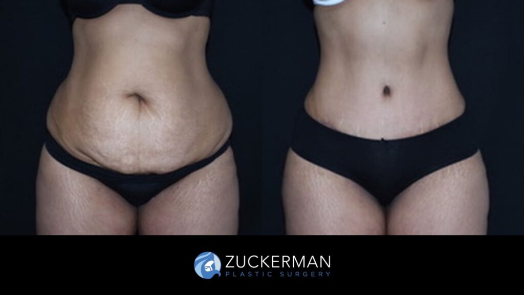 Patient Before and after Liposuction by Dr. Zuckerman.