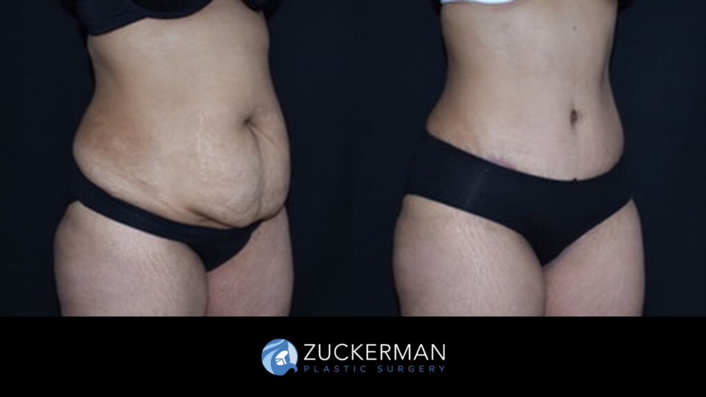 Patient Before and after Liposuction by Dr. Zuckerman.