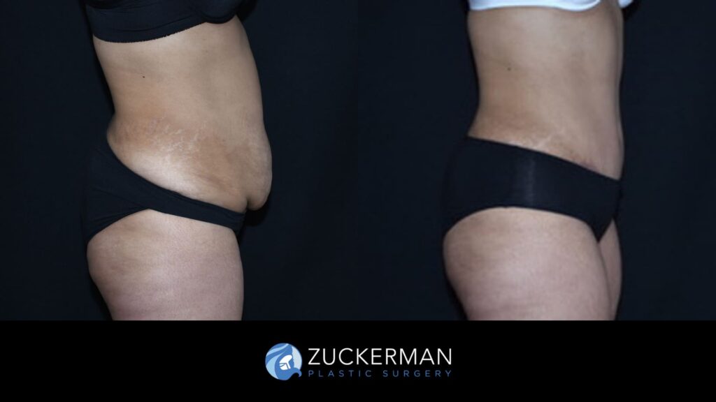 Patient Before and after Liposuction by Dr. Zuckerman.