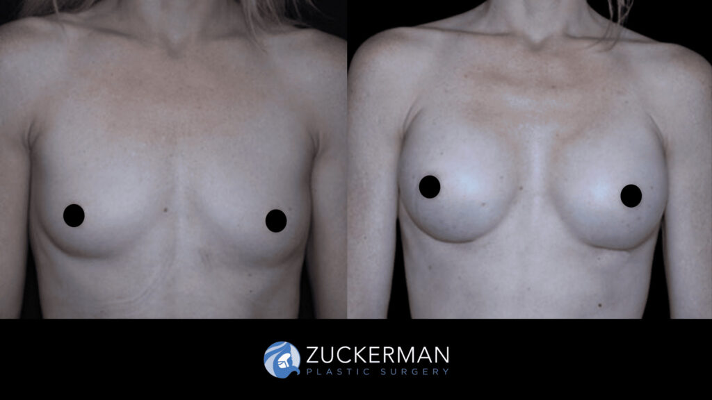 Patient before and after Breast Augmentation | Zuckerman Plastic Surgery