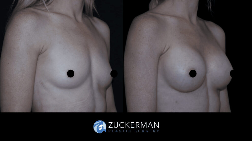 Patient before and after Breast Augmentation | Zuckerman Plastic Surgery
