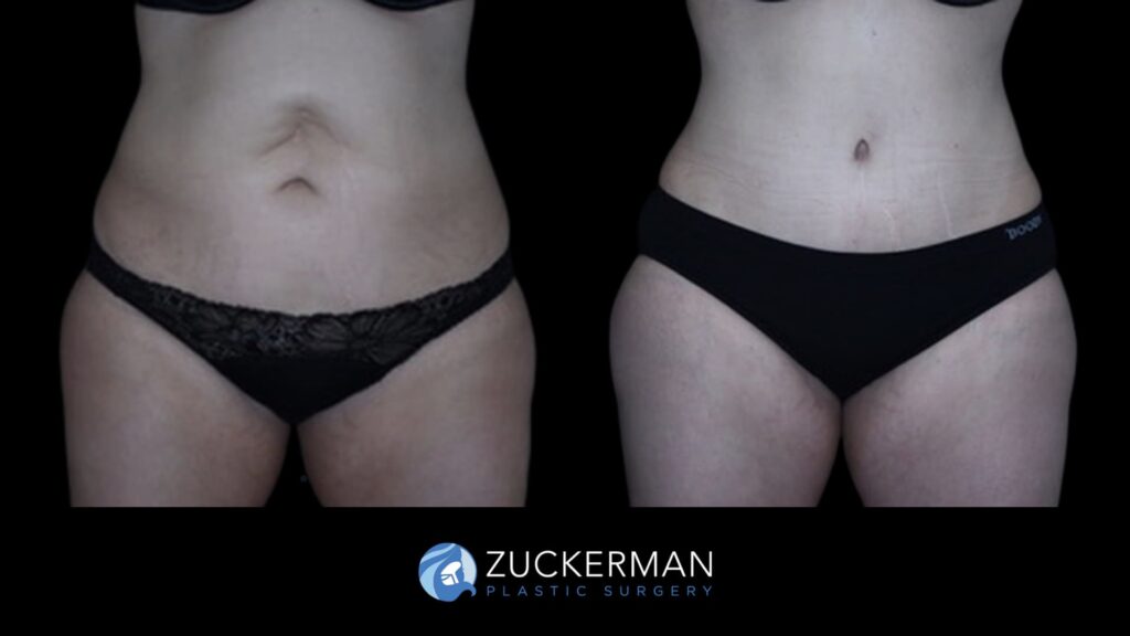 Patient before and after Tummy Tuck | Zuckerman Plastic Surgery