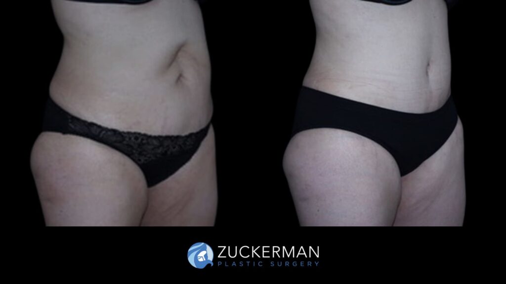 Patient before and after Tummy Tuck | Zuckerman Plastic Surgery