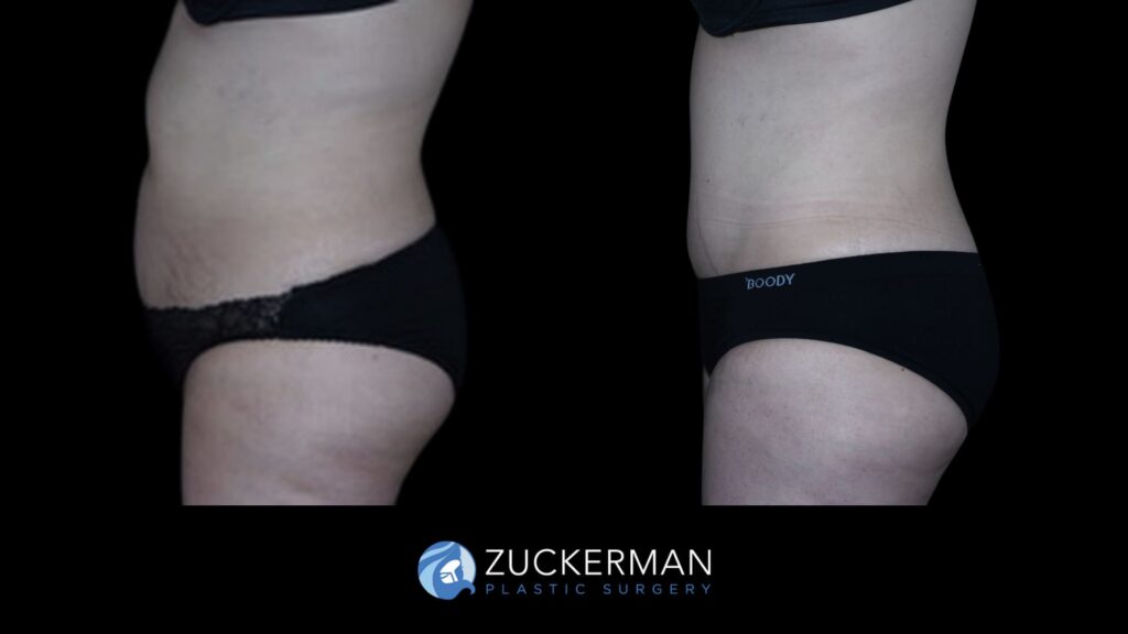 Patient before and after Tummy Tuck | Zuckerman Plastic Surgery