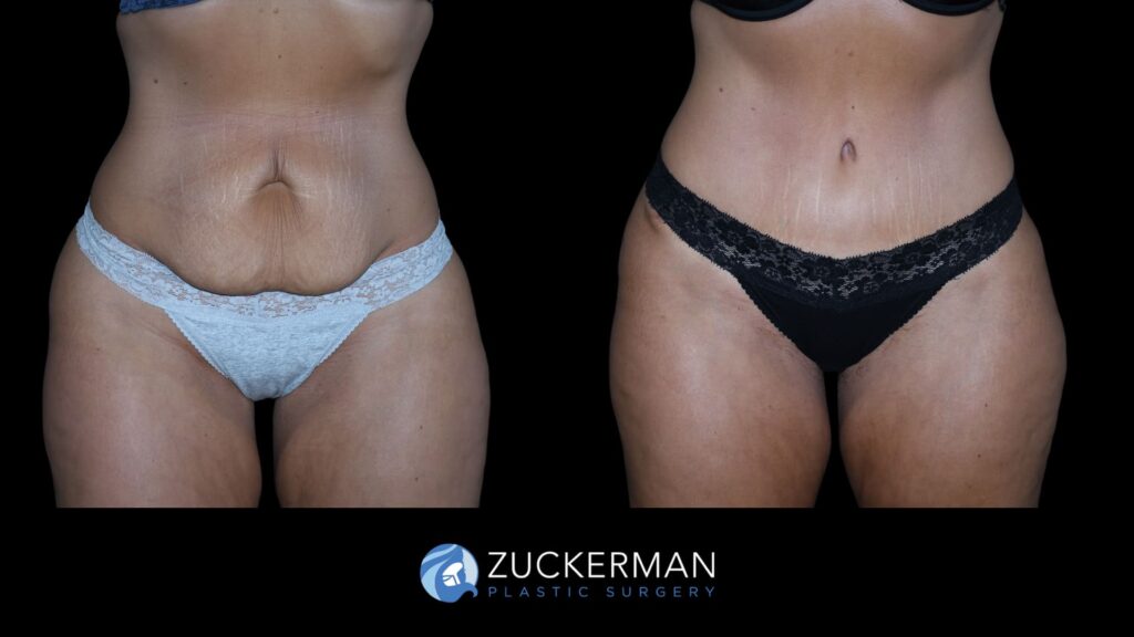 Patient 12 Tummy Tuck 1 license confirmed