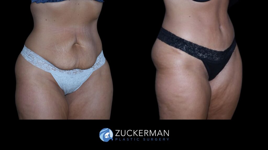 Patient before and after Tummy Tuck | Zuckerman Plastic Surgery