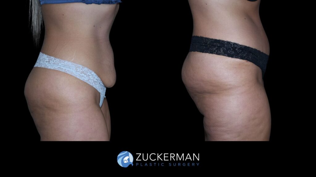 Patient before and after Tummy Tuck | Zuckerman Plastic Surgery