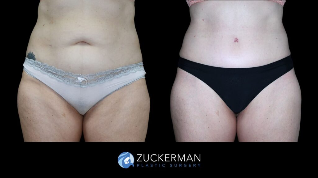 Patient before and after Tummy Tuck | Zuckerman Plastic Surgery
