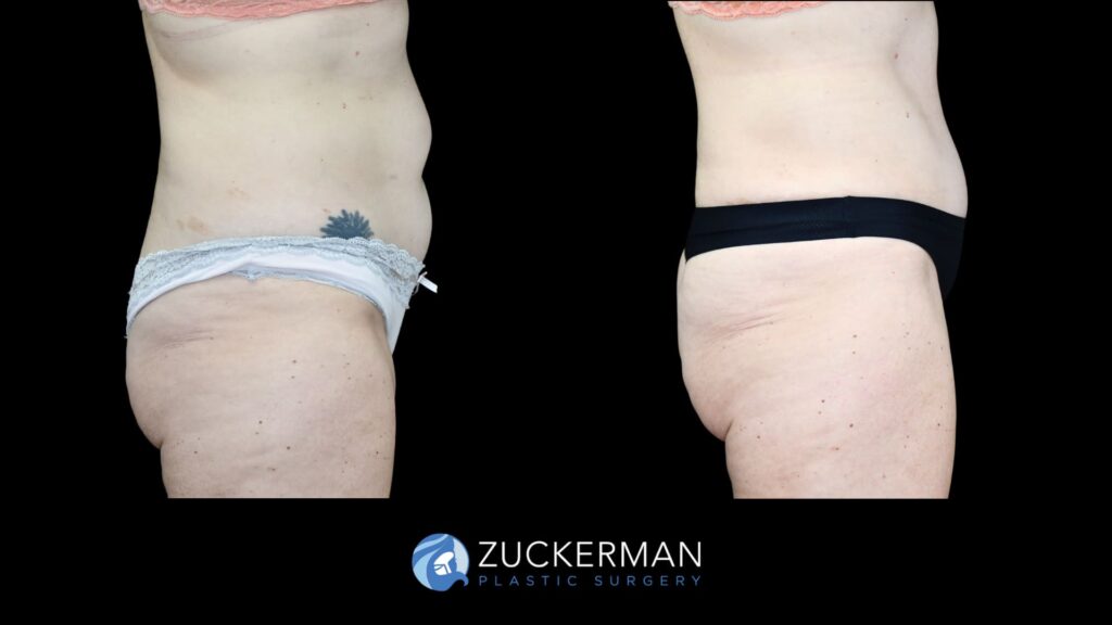 Patient before and after Tummy Tuck | Zuckerman Plastic Surgery
