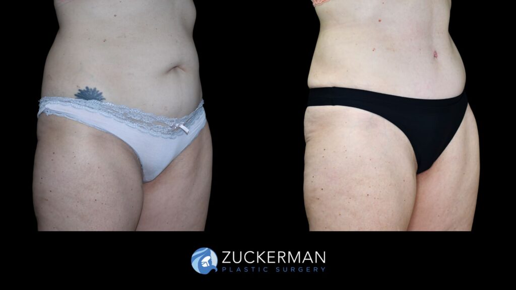 Patient before and after Tummy Tuck | Zuckerman Plastic Surgery
