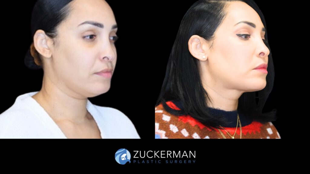 Patient before and after Submental Liposuction and Renuvion by Dr. Zuckerman.
