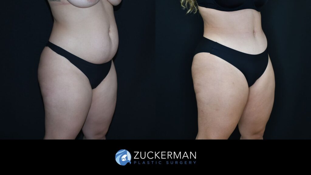 Patient before and after Tummy Tuck | Zuckerman Plastic Surgery