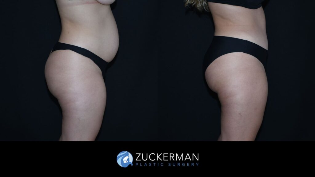 Patient before and after Tummy Tuck | Zuckerman Plastic Surgery