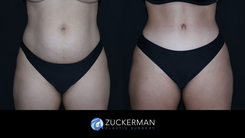 Patient before and after Tummy Tuck | Zuckerman Plastic Surgery