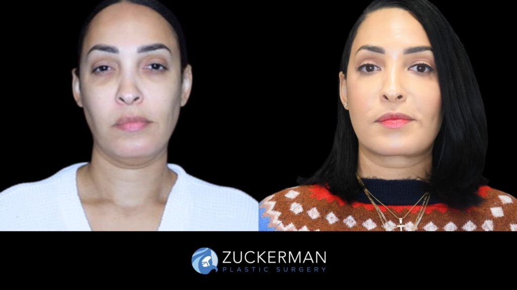 Patient before and after Submental Liposuction and Renuvion by Dr. Zuckerman.