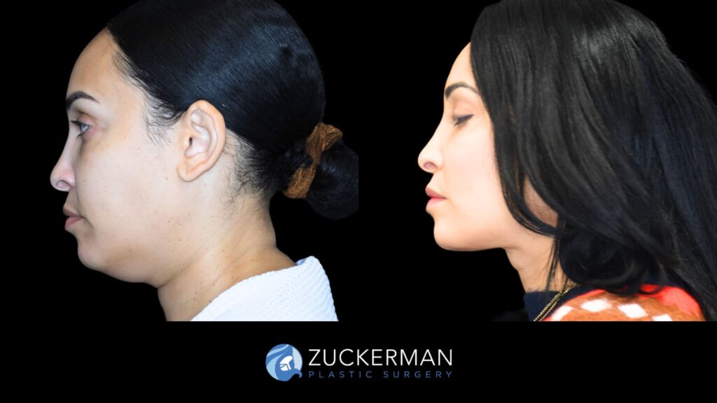 Patient before and after Submental Liposuction and Renuvion by Dr. Zuckerman.